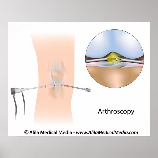 Póster Diagrama de artroscopía de rodilla. (Frente)