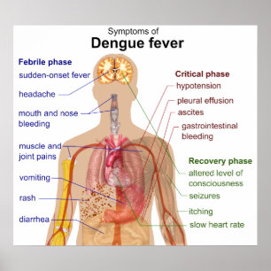 Póster Diagrama de los principales síntomas del dengue