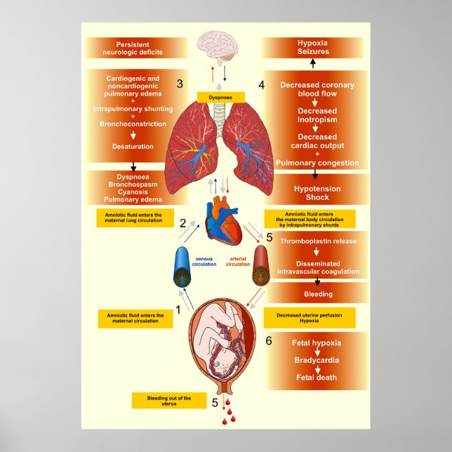Póster Diagrama de un embolismo fluido amniótico (Frente)