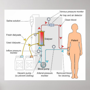 Póster Diagrama de un tratamiento médico de hemodiálisis
