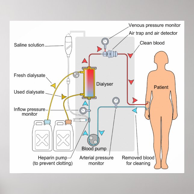 Póster Diagrama de un tratamiento médico de hemodiálisis (Frente)