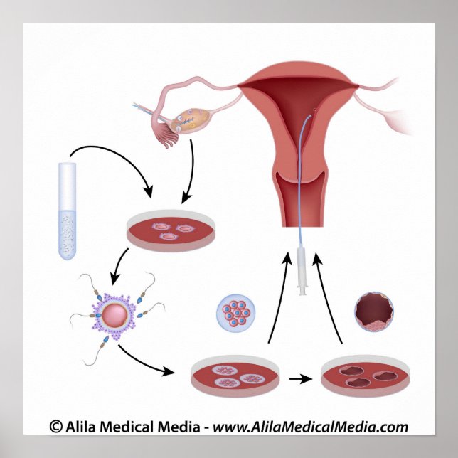 Póster diagrama sin etiqueta de procedimiento IVF. (Frente)