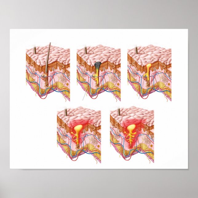 Póster Diferentes Tipos De Acné