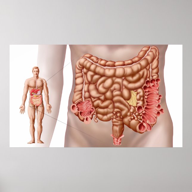 Póster Diverticulitis En La Región Colónica Descendente (Frente)
