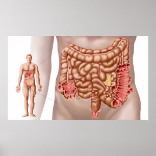 Póster Diverticulitis en la región de los dos puntos