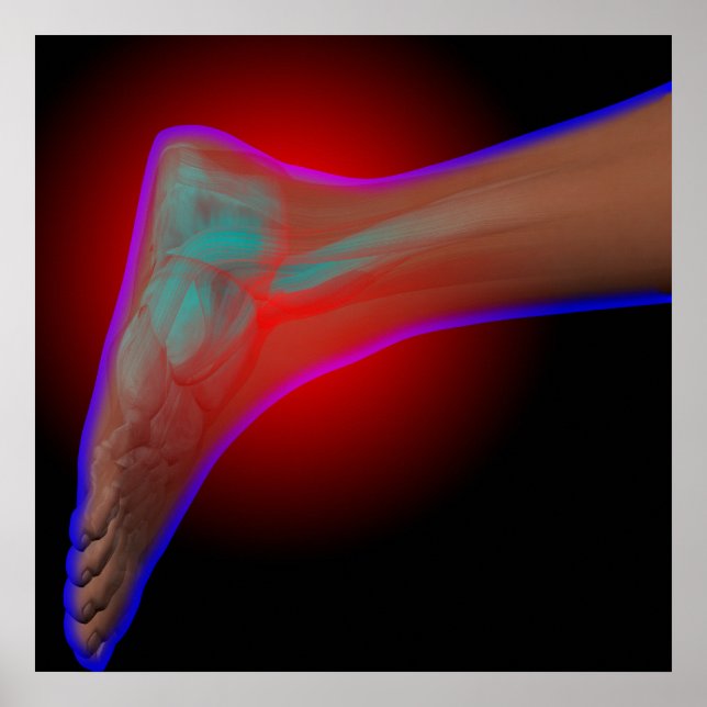 Póster Dolor de ánkle (Frente)