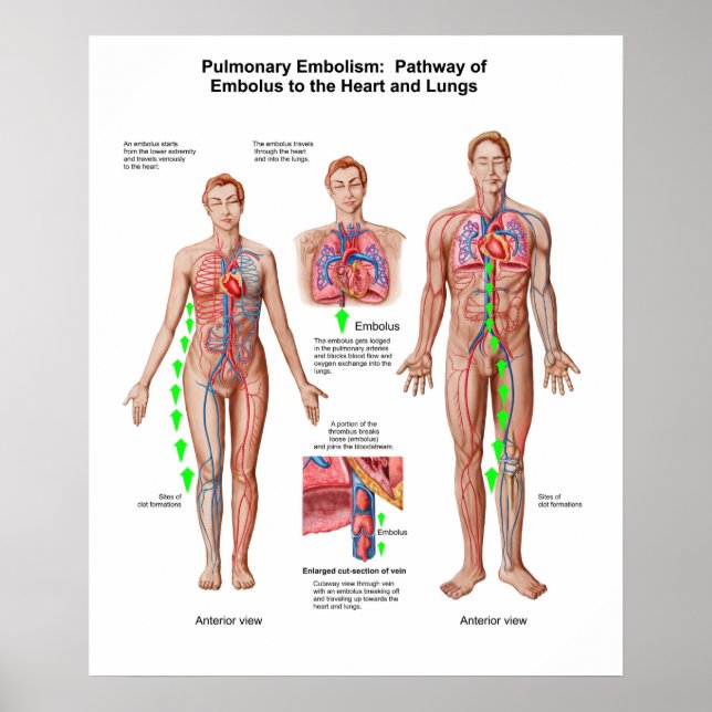 Póster Embolismo Pulmonar, Camino Del Emboluo (Frente)