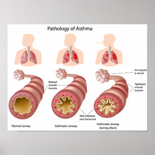Póster Enfermedad pulmonar Asma Poster