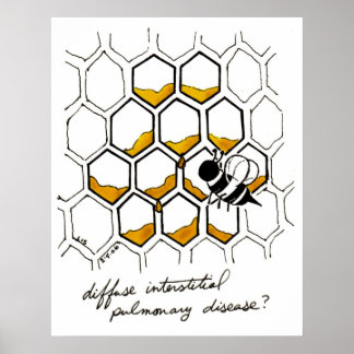 Póster Enfermedad pulmonar intersticial difusa