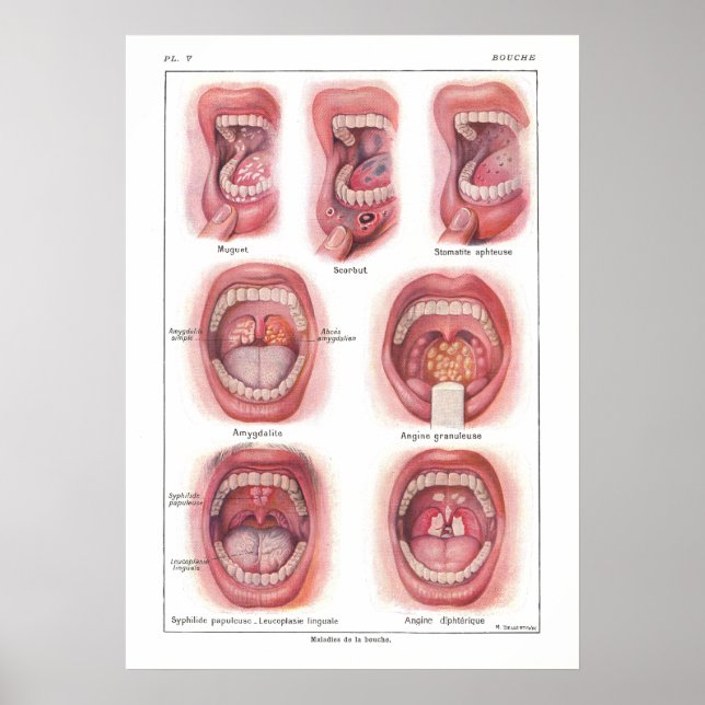 Póster Enfermedades de la anatomía bucal Poster francés (Frente)