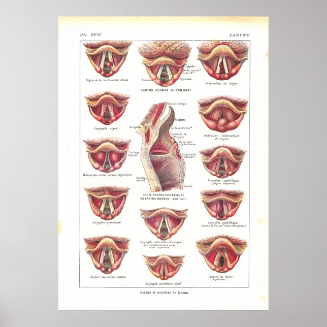 Póster Enfermedades de Larynx Anatomy Poster Francés (Frente)
