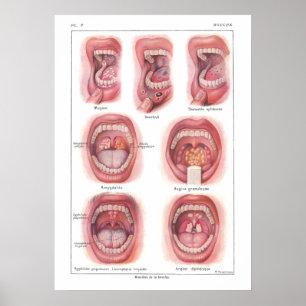 Póster Enfermedades del francés del poster de la anatomía