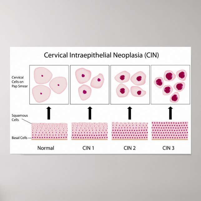 Póster Estadios de displasia cervical y prueba de Papanic (Frente)
