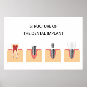 Póster Estructura del implante dental