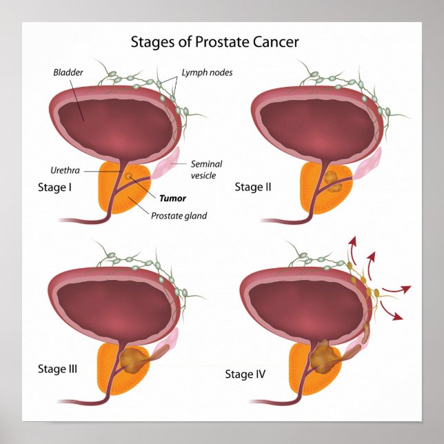 Póster Etapas del Poster de cáncer de próstata (Frente)
