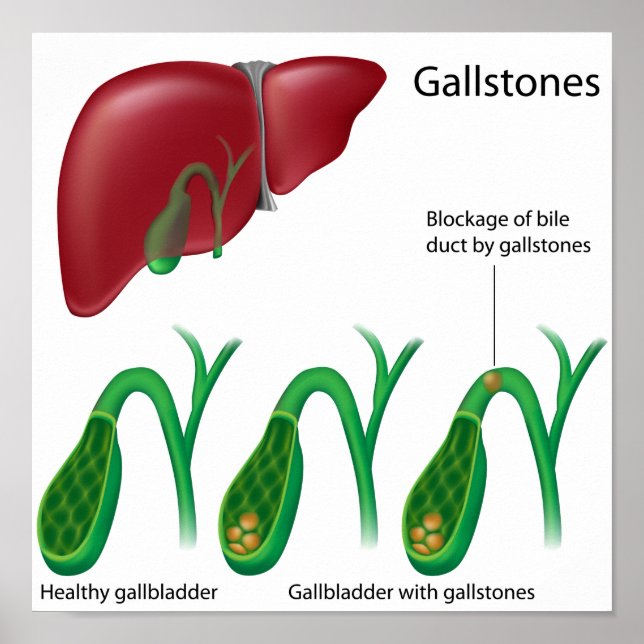 Póster Gallstones y Poster Hepático (Frente)