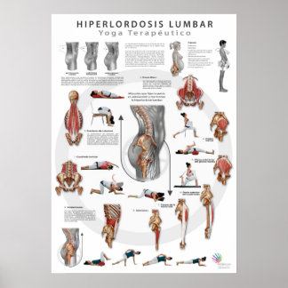 Póster Hiperlordosis - definición, causas y tratamiento