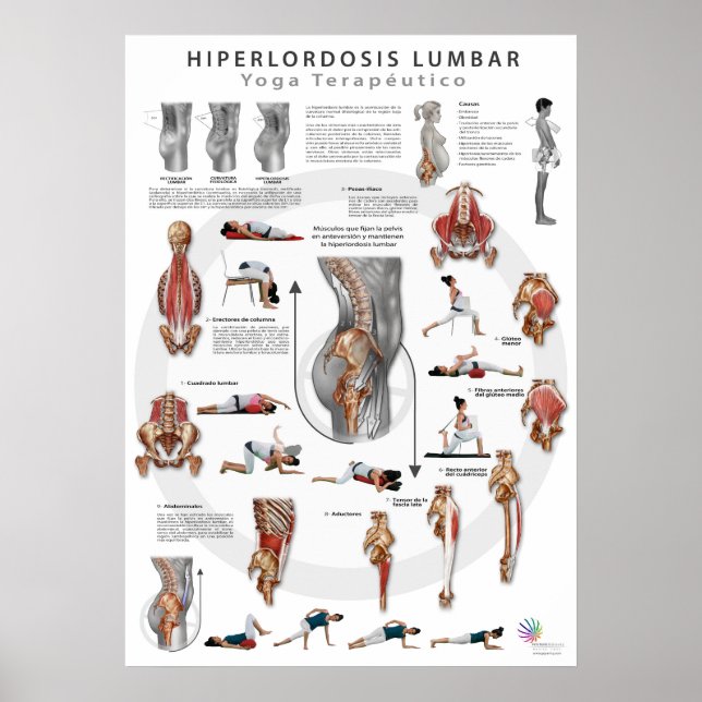 Póster Hiperlordosis - definición, causas y tratamiento (Frente)