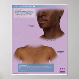 Póster Hiperpigmentación Melalógica Poster médico