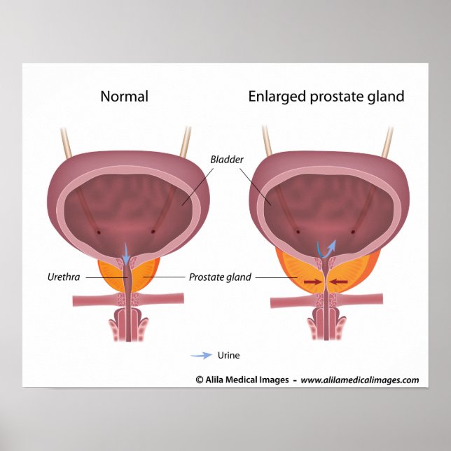 Póster Hiperplasia prostática benigna, diagrama marcado. (Frente)