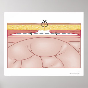 Póster Illustration of a Hernia