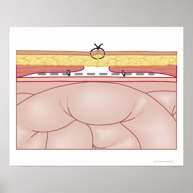 Póster Illustration of a Hernia (Frente)