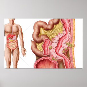 Póster Ilustracion De Diverticulosis En El Colón