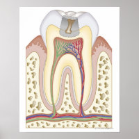 Ilustracion de la caries dental
