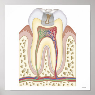 Póster Ilustracion de la caries dental