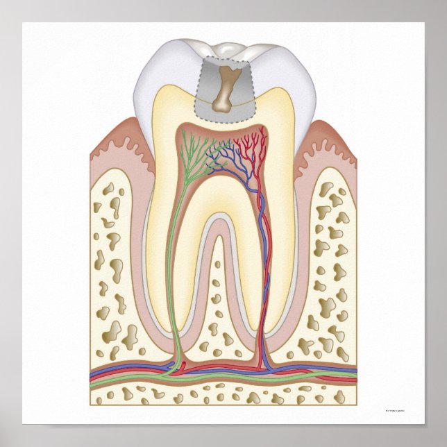 Póster Ilustracion de la caries dental (Frente)