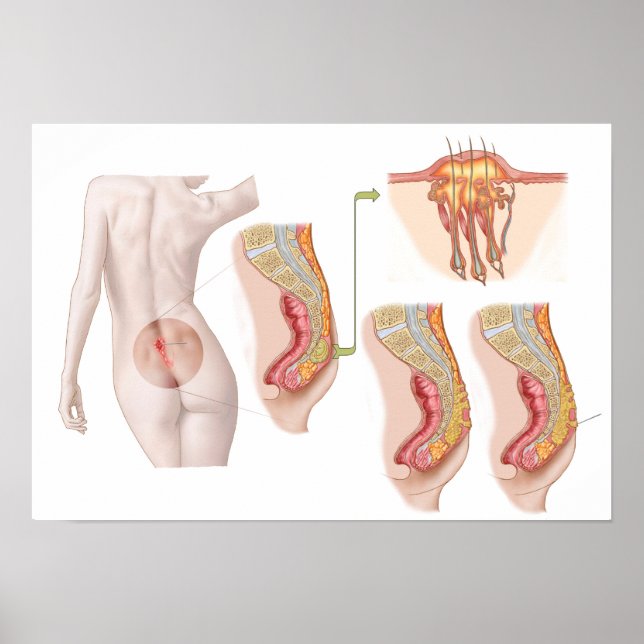 Póster Ilustración Médica De Un Ciclo Pilonidal (Frente)