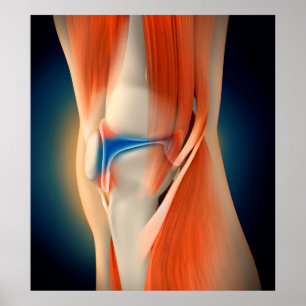 Póster Ilustracion médico: Inflamación en rodilla