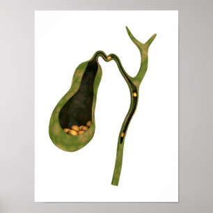 Póster Imagen Conceptual De Gallstones Inside Gall