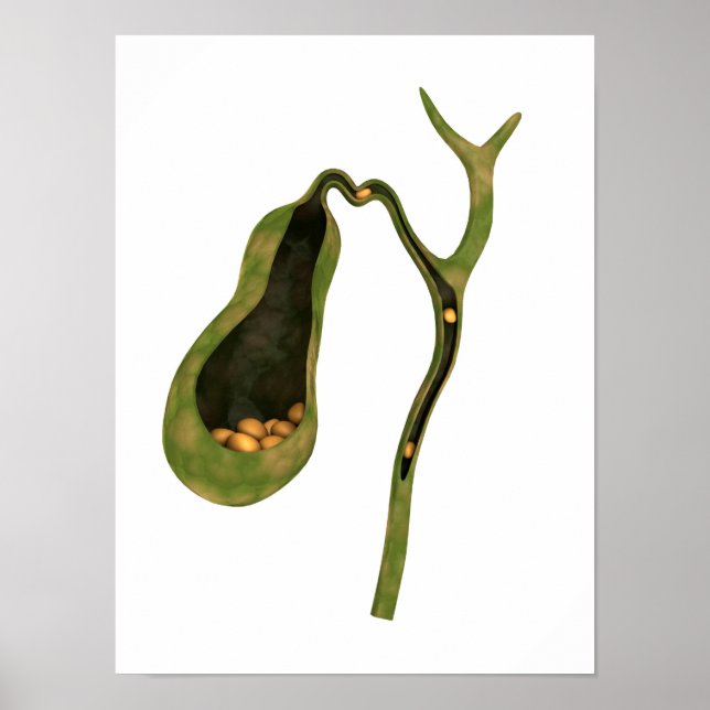 Póster Imagen Conceptual De Gallstones Inside Gall (Frente)