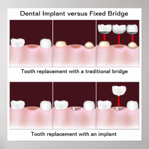 Póster Implante dental versus Poster puente