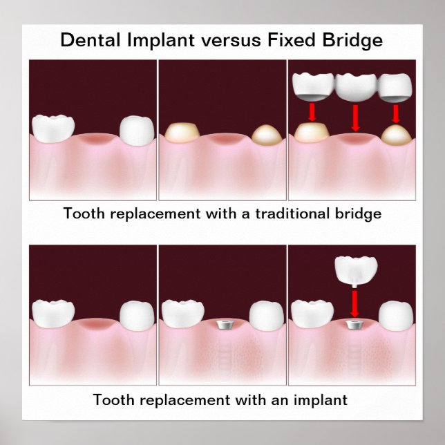 Póster Implante dental versus Poster puente (Frente)