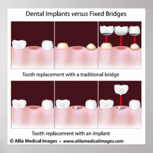 Póster Implante dental versus Poster puente