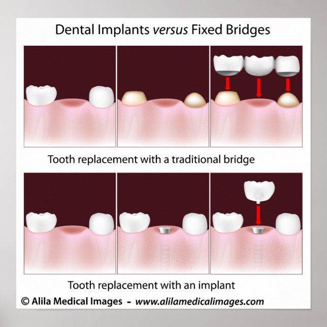 Póster Implante dental versus Poster puente (Frente)