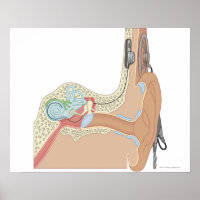 Implantes cocleares