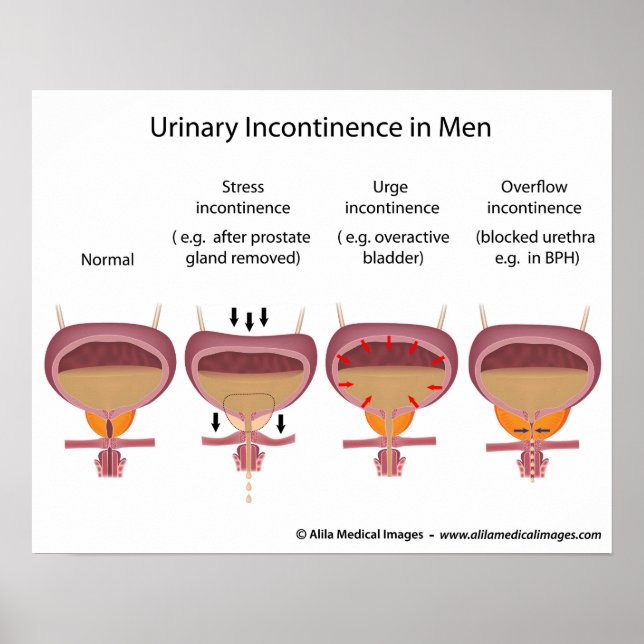 Póster Incontinencia urinaria masculina (Frente)