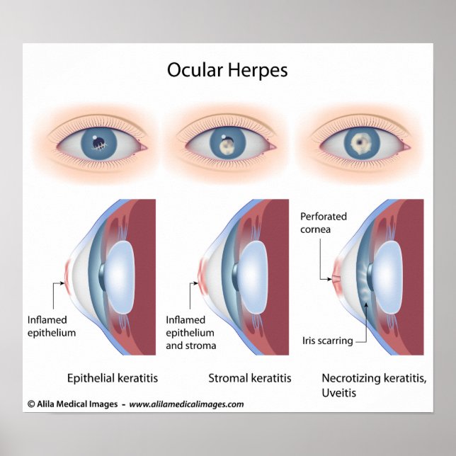 Póster Infección por herpes oculares, diagramas etiquetad (Frente)