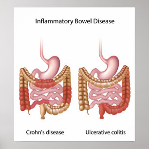 Póster inflammatory bowel disease (ibd) poster