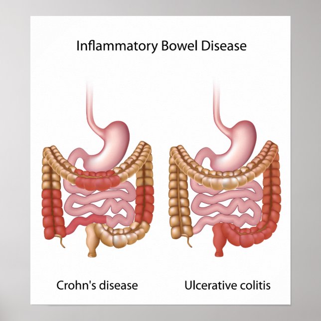 Póster inflammatory bowel disease (ibd) poster (Frente)
