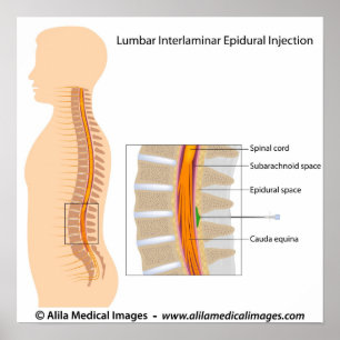 Póster Inyección epidural lumbar, diagrama marcado.