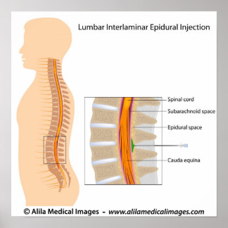 Póster Inyección epidural lumbar, diagrama marcado.