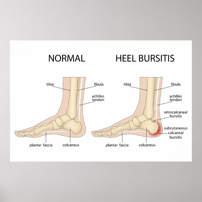 Póster La deformidad de Haglund (Frente)