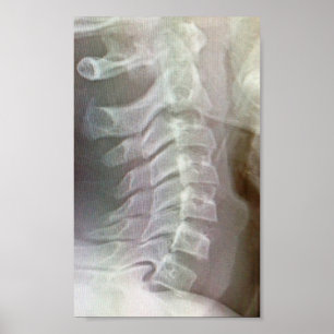 Póster Lazo cervical de la espina dorsal