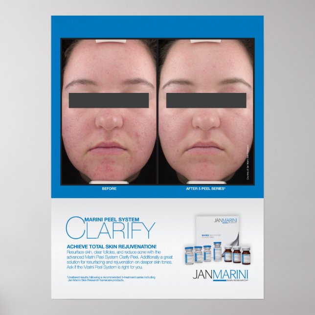 Póster Marini Peel Clarify Results 18x24" (Frente)
