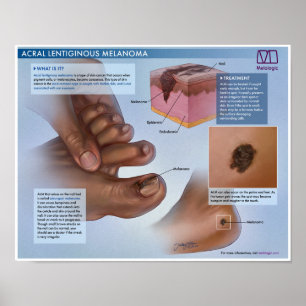 Póster Melalogic Acral Lentiginoso Melanoma Poste Médico