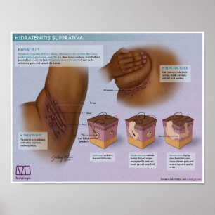 Póster Melalogic Hidradenitis Poster Médico Supprativa